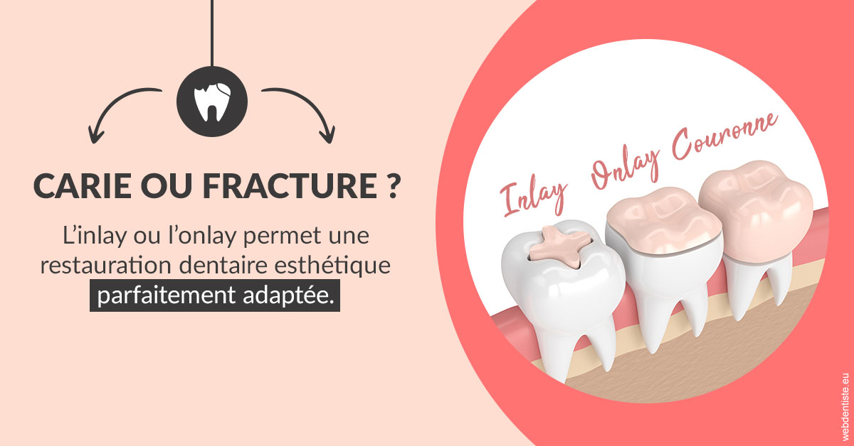 https://www.dentistes-lafontaine-ducrocq.fr/T2 2023 - Carie ou fracture 2
