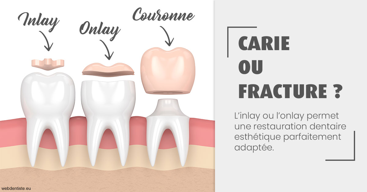 https://www.dentistes-lafontaine-ducrocq.fr/T2 2023 - Carie ou fracture 1