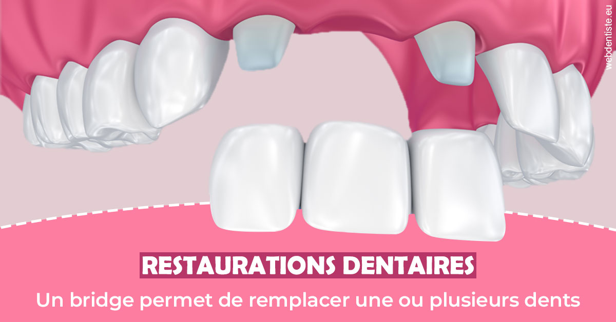 https://www.dentistes-lafontaine-ducrocq.fr/Bridge remplacer dents 2