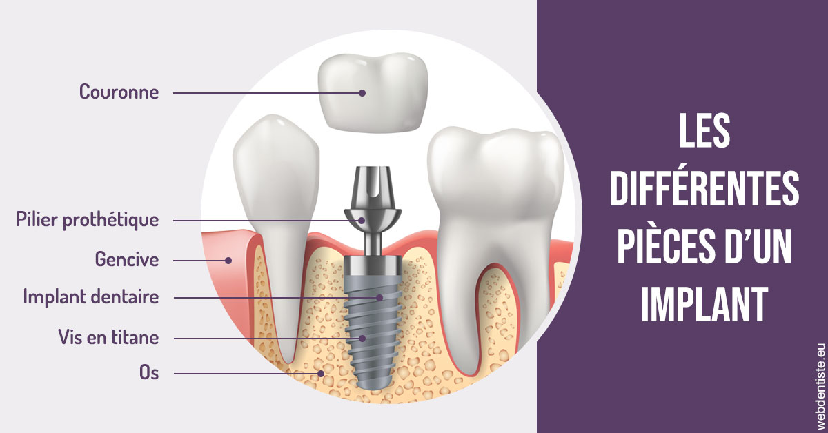 https://www.dentistes-lafontaine-ducrocq.fr/Les différentes pièces d’un implant 2