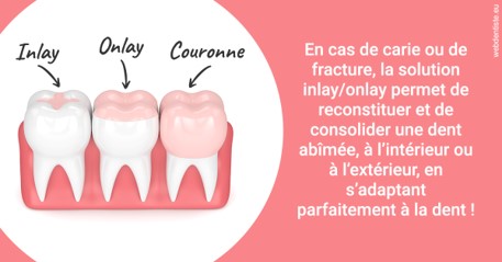 https://www.dentistes-lafontaine-ducrocq.fr/L'INLAY ou l'ONLAY 2