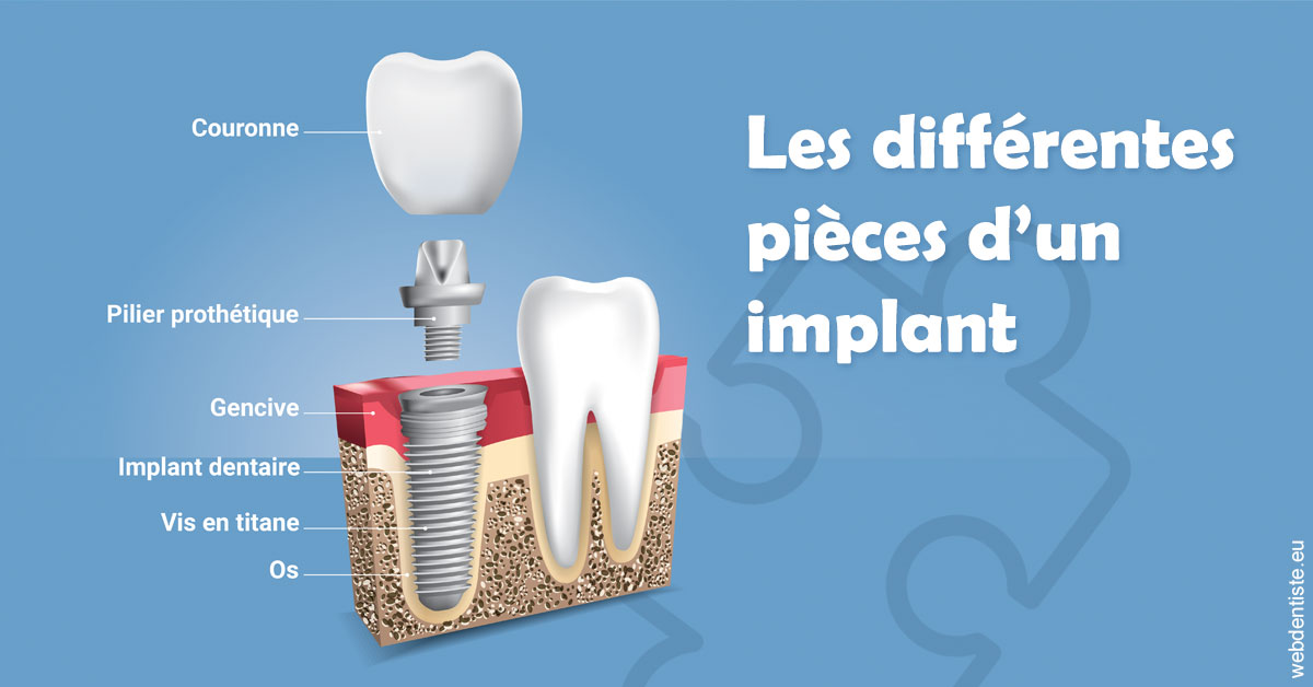 https://www.dentistes-lafontaine-ducrocq.fr/Les différentes pièces d’un implant 1