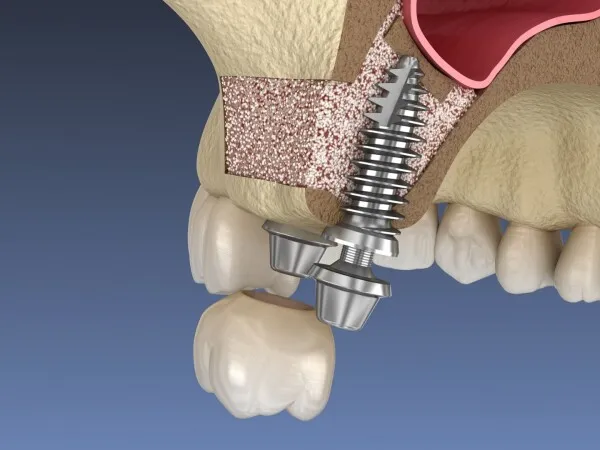 Greffe osseuse intra sinusienne ou sinus lift