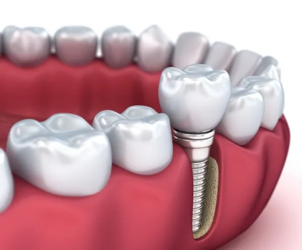 Implants : questions - réponses