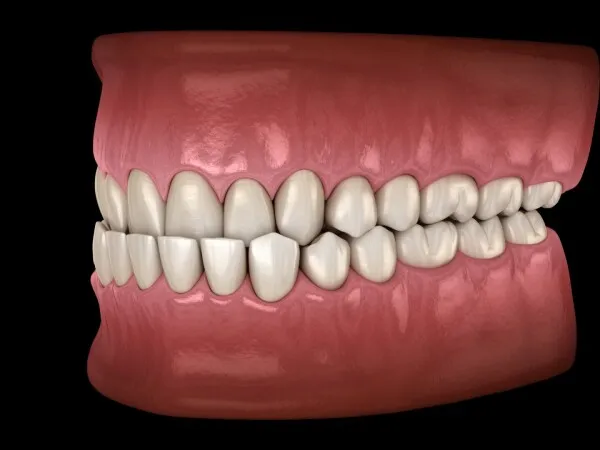Occlusion dentaire