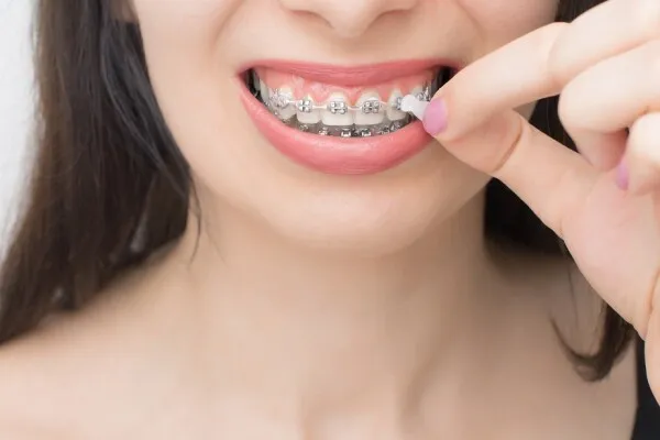 Incident orthodontique