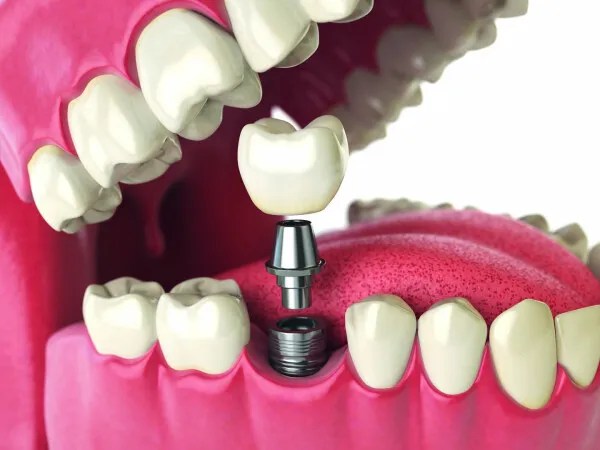Pose d'implants dentaires