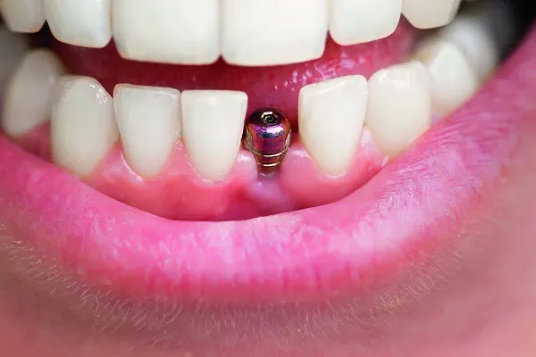Pose d'implants dentaires