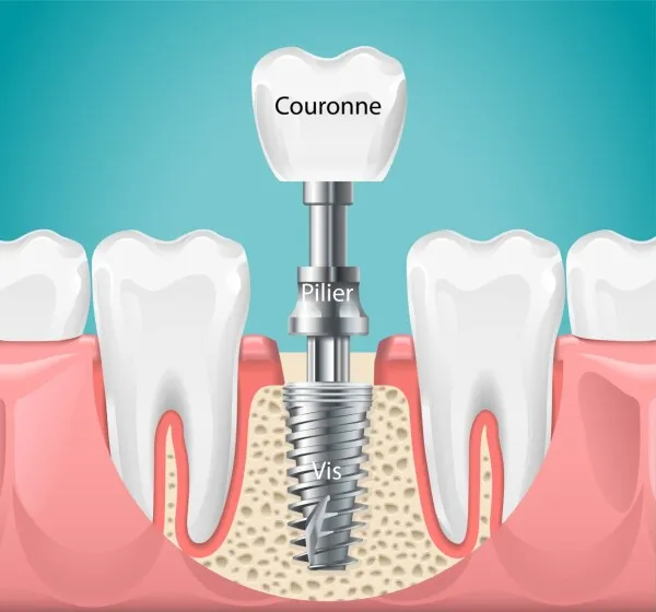 Qu’est-ce qu’un implant ? Indications et contre-indications