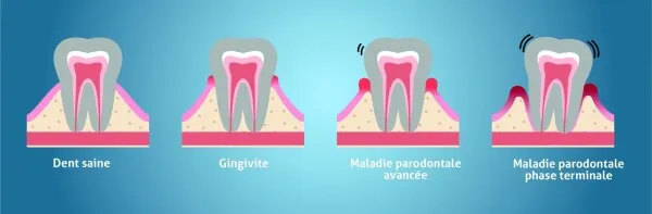 Parondontites