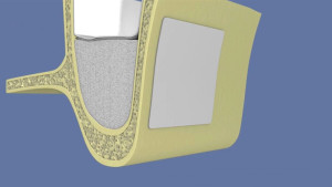 Comblement de sinus par abord latéral sans pose d’implant