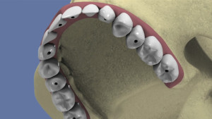 Maxillaire complet et traitement implantaire pour un bridge fixe vissé