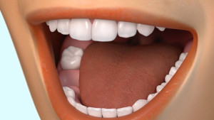 Conséquence de la perte des dents postérieures