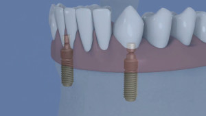 Stabilisation d'une prothèse par deux boutons pressions