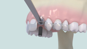 Chirurgie mini-invasive (Flapless Guidée)
