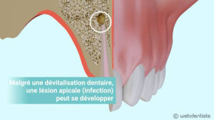 Résection apicale