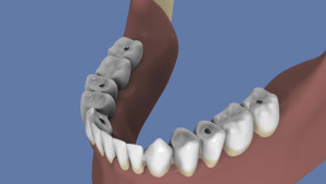Mandibule :  Bridge complet vissé sans fausse gencive